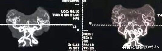 小儿头发卷曲，可能是患上了一种病...