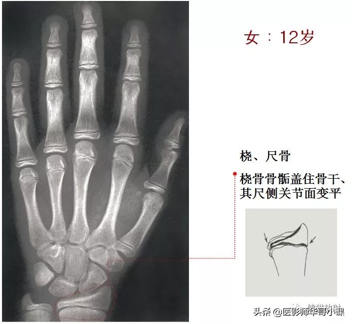 骨龄片对照图谱测骨龄准不,骨龄14岁男孩骨龄图谱