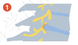 颈椎生理曲度变直有骨刺怎么办,颈椎x线片能看到什么吗