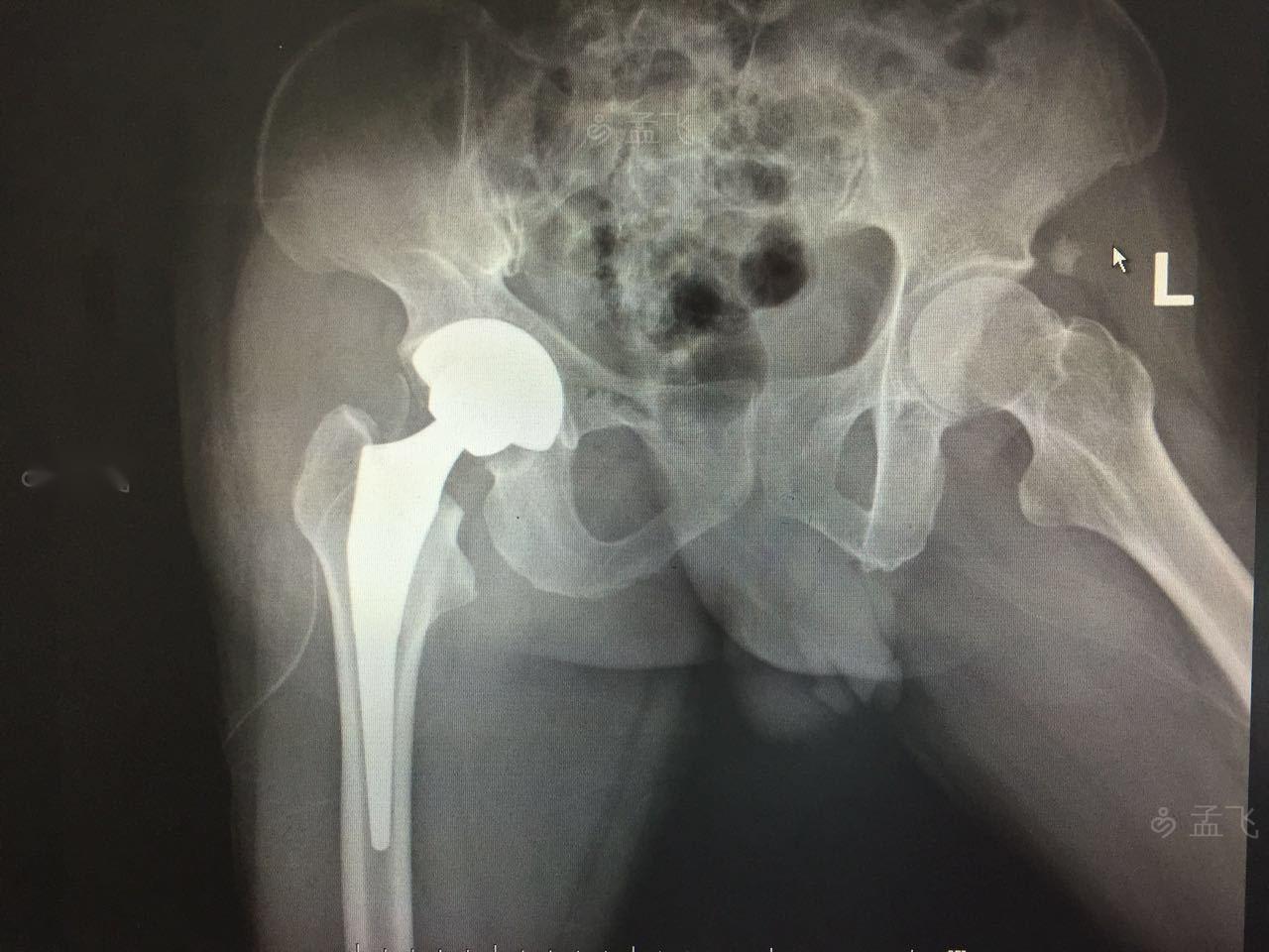 左股骨颈骨折被称为最后一次骨折,髋关节骨折和股骨颈骨折区别在哪