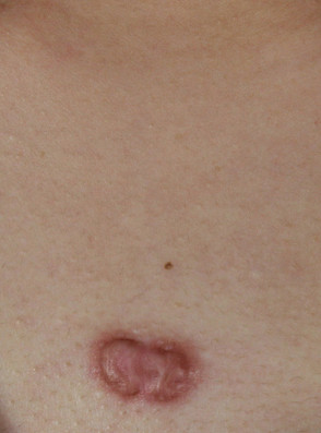 疤痕体质用什么方法祛疤好,欣奕除疤凝胶对疤痕体质有效果吗