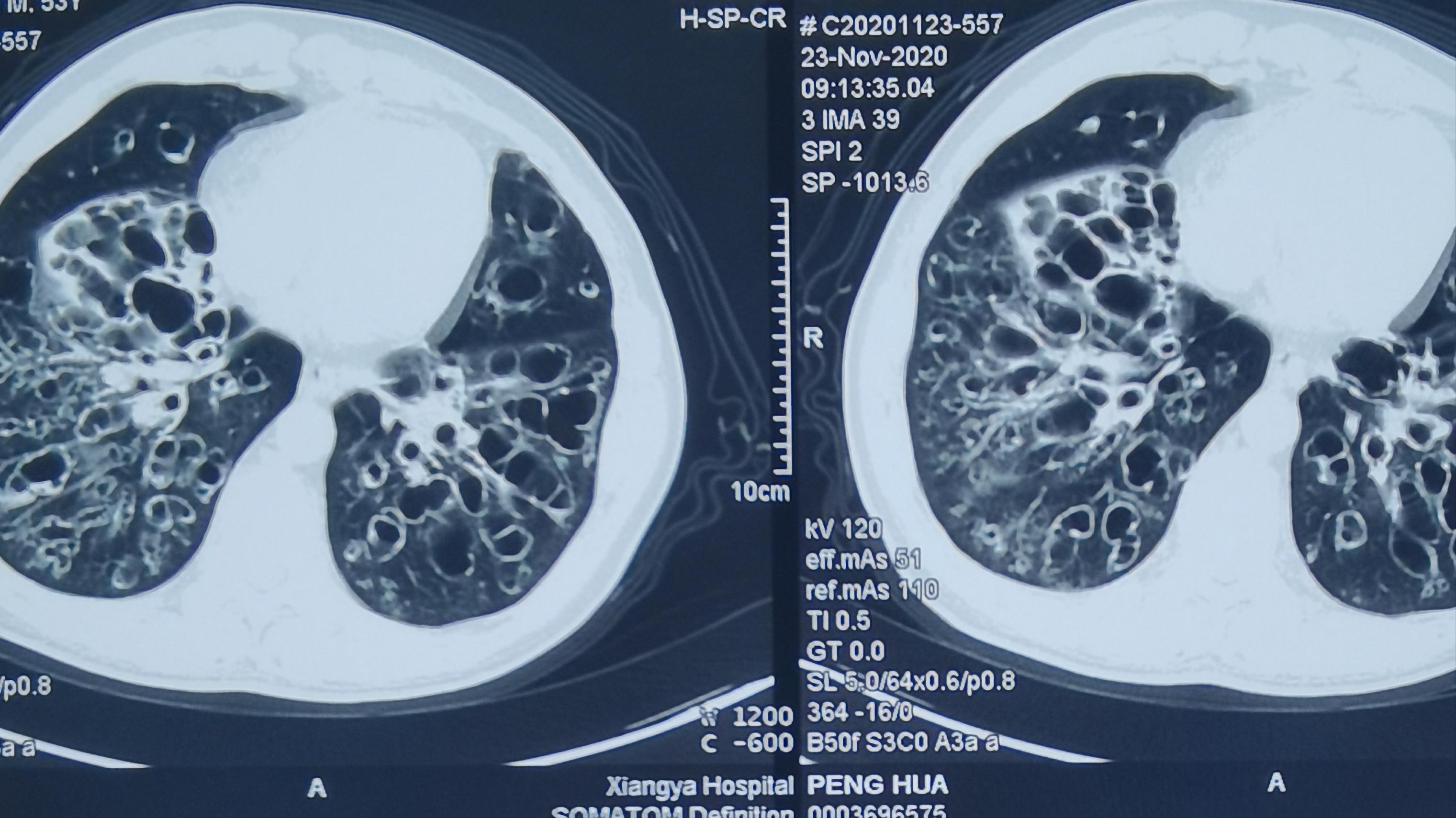 36岁支气管轻度扩张能活多久,51岁支气管扩张30多年了还咳血