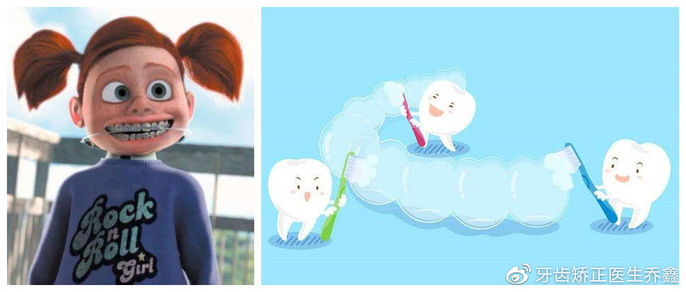 矫正牙齿戴牙套好还是隐形牙套好,牙齿矫正用隐形牙套还是传统牙套