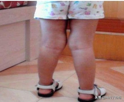 宝宝腿部弯曲不正常图片,宝宝腿畸形是因为什么