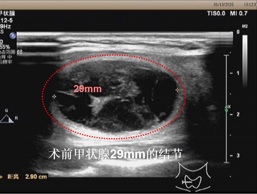 哈尔滨微创消融甲状腺结节哪家好,甲状腺结节微创消融术的过程