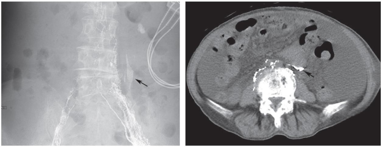 盆腔囊性淋巴管瘤可以治愈吗,盆腔淋巴管囊肿