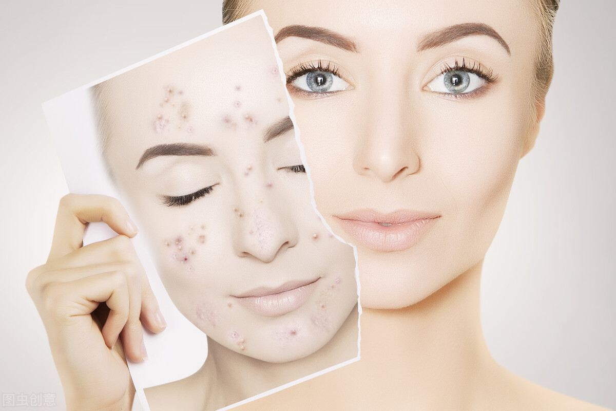 激光祛痘坑要多少钱,痘坑凹洞激光修复多少钱一次