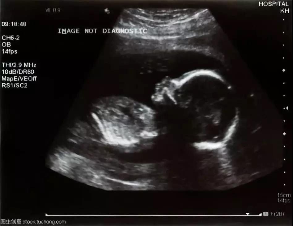 产检B超:二维、三维、四维超声有什么不一样?产检要做几次B超?