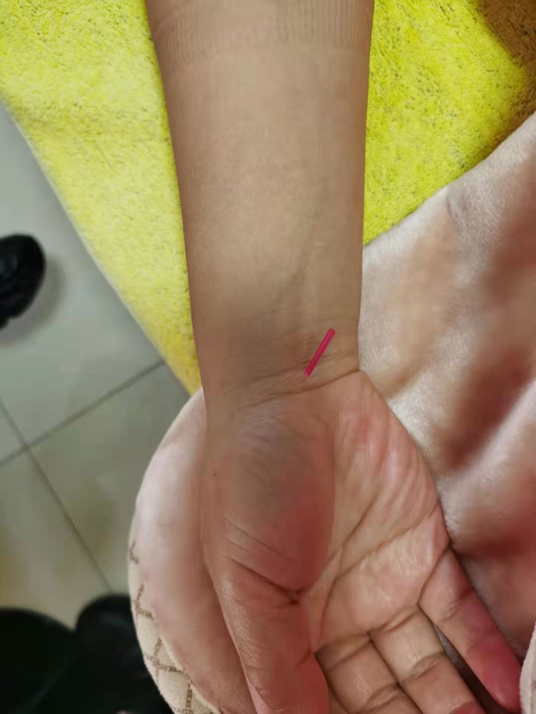 针灸治疗眩晕副作用,颈椎针灸能治疗眩晕吗