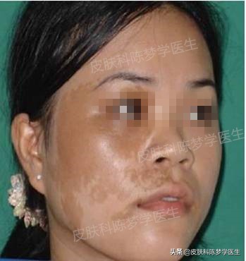 褐青斑是雀斑样痣吗,脸上太田痣怎么祛斑