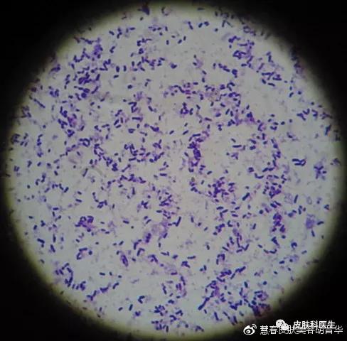 是不是皮肤癣，皮肤真菌镜检来告诉你！