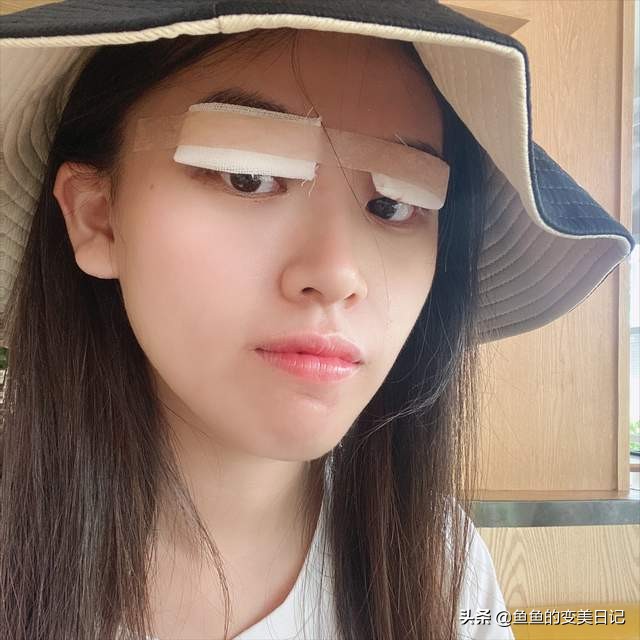 双眼皮知识点总结大全,关于双眼皮的十大真相