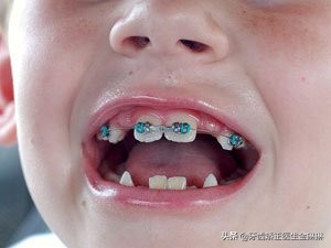 八岁男孩刚换牙牙齿长歪怎么办,小孩牙齿换牙后长歪了怎么办