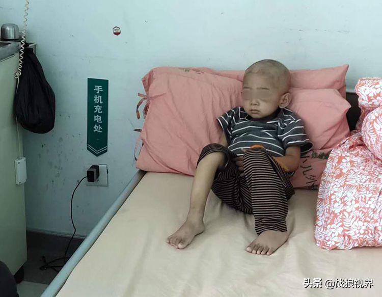 小孩摔一跤后引起眼袋淤青,2岁多男宝眼袋浮肿有点发紫