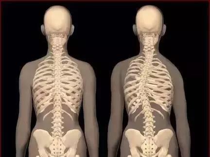 脊柱侧弯矫正视频教程完整,脊柱侧弯中医正骨矫正视频
