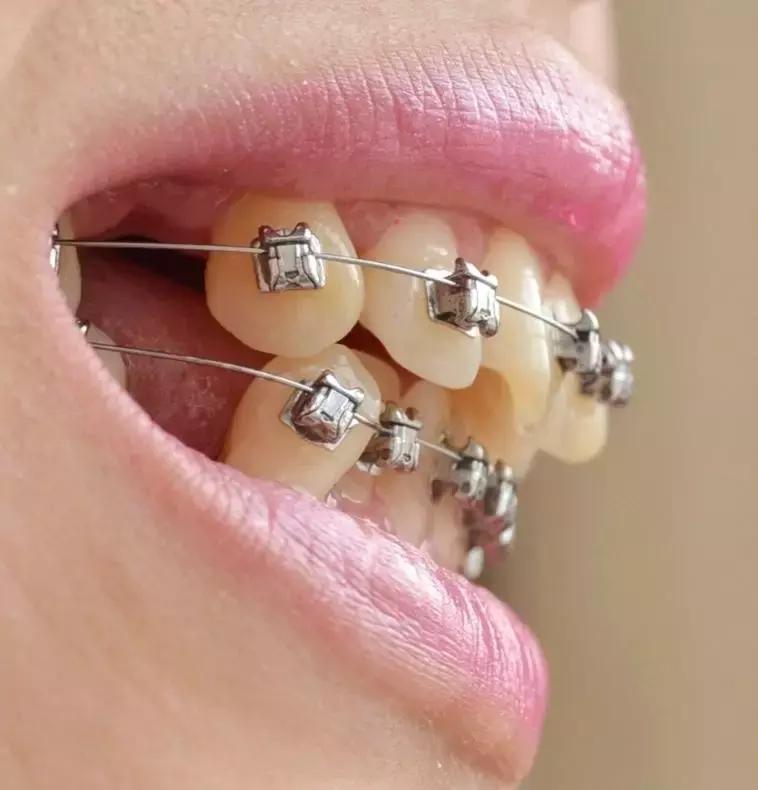 为什么矫正完牙还能反弹呢,为什么矫正完牙齿上门牙还是凸