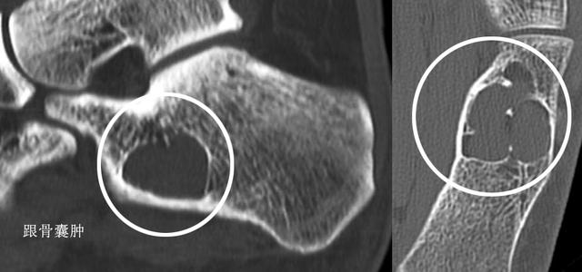 跑步足跟痛的原因及治疗方法,产后足跟痛是什么原因引起的