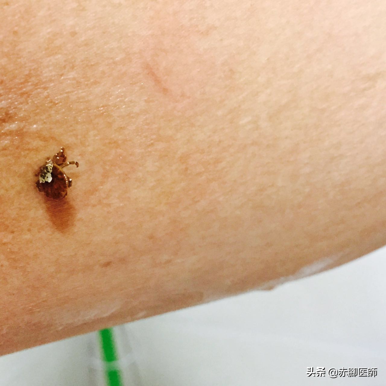 蜱虫叮咬后正确处理方法,蜱虫长期叮咬在人身上会怎样