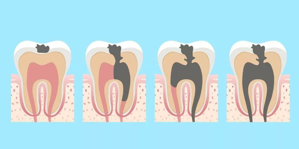 根管治疗全冠修复多少钱,根管治疗以后要做全冠吗