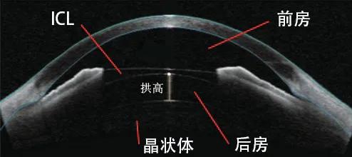 1700度近视可以摘镜,近视1600度戴800度眼镜