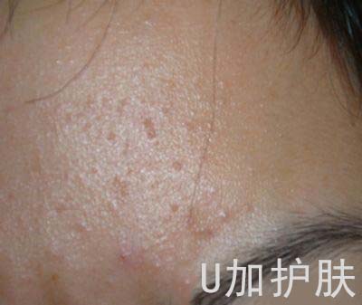 脸上的油脂粒如何去除,怎样有效去除脸上的油脂粒