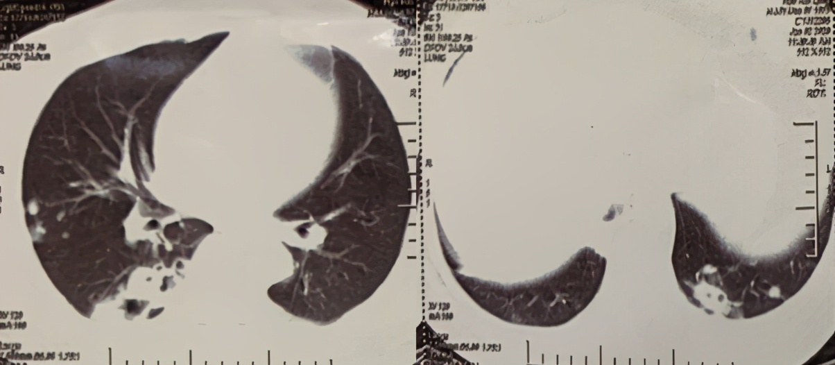 木雕老人突然咳嗽、咯血,肺上长了个大窟窿!这种真菌就潜藏在我们身边