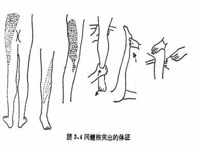 腰椎间盘突出症的临床诊治策略,腰椎间盘突出症的临床诊治