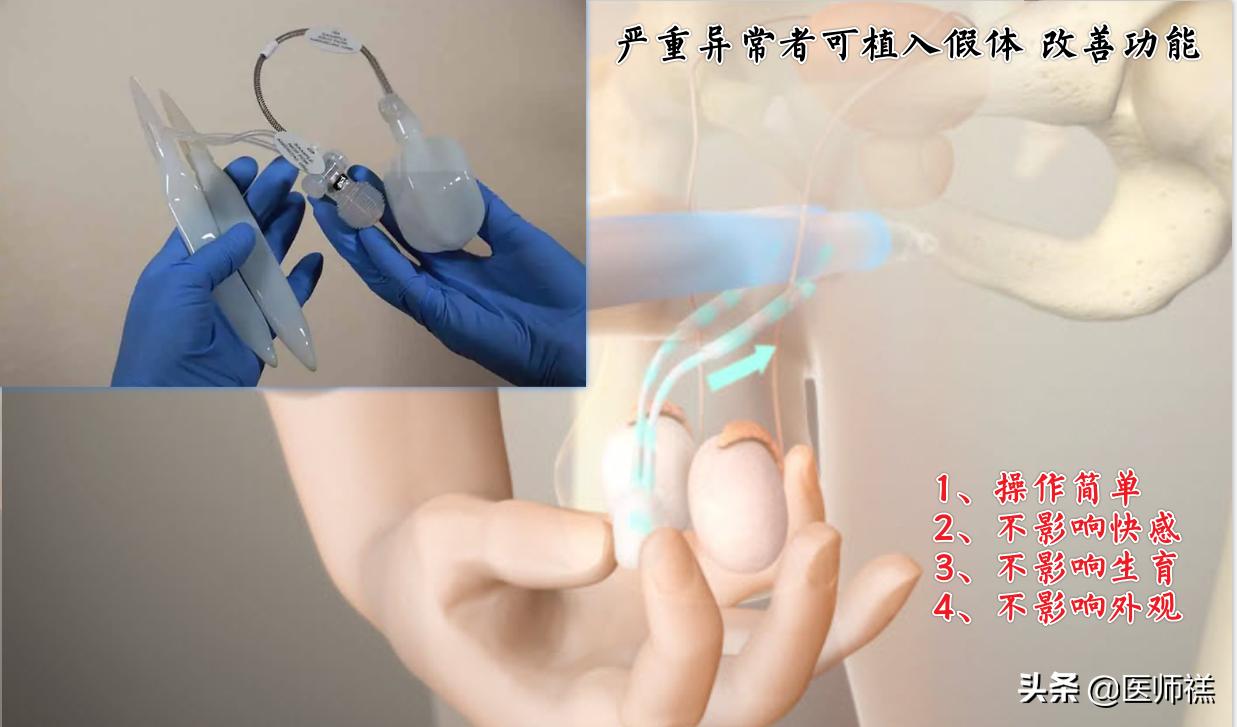 蓝色小药丸你用对了吗,第一次吃蓝色小药丸有副作用吗