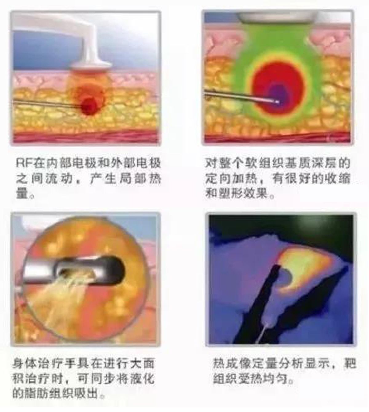 黄金微雕跟维密脂雕是一回事吗,黄金微雕和维密脂雕哪个好
