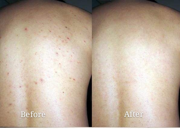 白天身上螨虫多是什么症状,身上螨虫多影响护肤吗