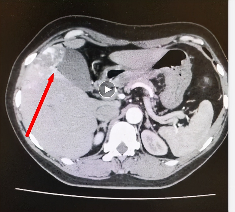 肝血管瘤为什么要切除胆囊,肝脏血管瘤微创手术需要住院吗