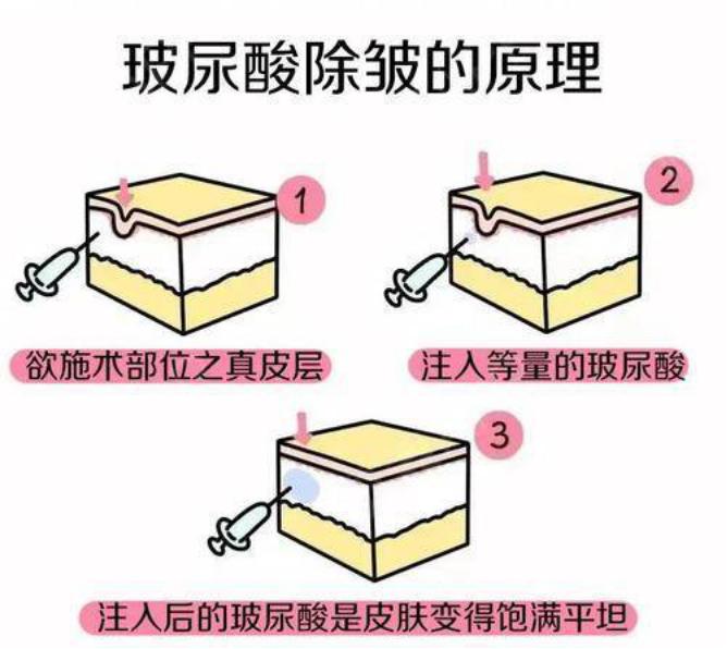 肉毒素和玻尿酸除皱哪个更实惠,如何选择肉毒素和玻尿酸注射除皱
