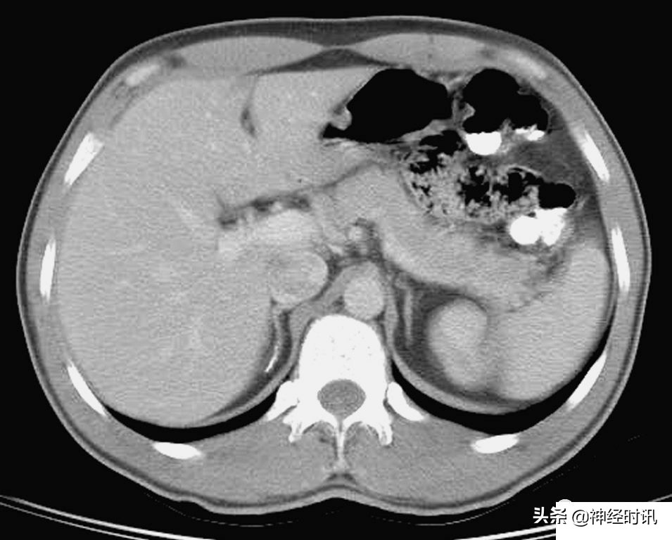 肾脏输尿管膀胱前列腺结构,肾输尿管膀胱解剖示意图