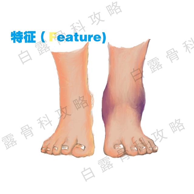 崴脚伤了脚踝怎么处理,崴到脚必须去正骨吗