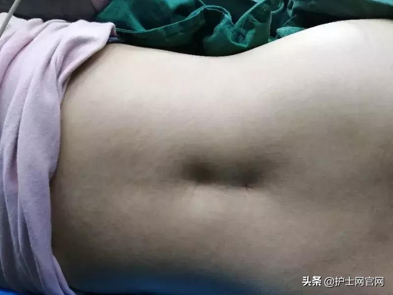 妊娠合并心衰的应急预案,妊娠合并心力衰竭处理原则