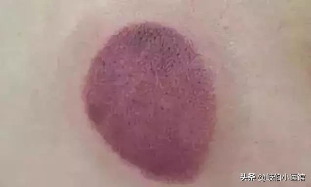 中医火罐疗法有哪些注意事项,中医火罐穴位图