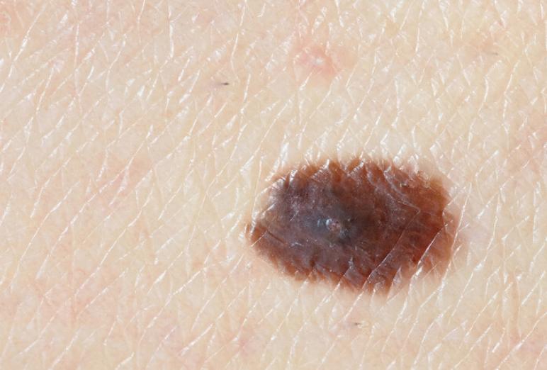 你身上有色素痣吗,你身上的痣有什么含义图片