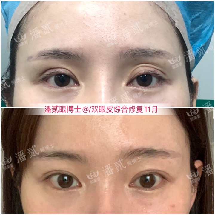 割双眼皮眼皮压下来会恢复吗,割双眼皮以后会松弛更快吗