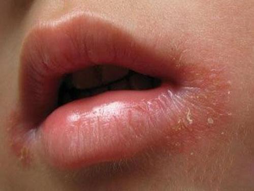 孩子上火了怎么预防感冒,小孩儿上火了该用什么方法治疗