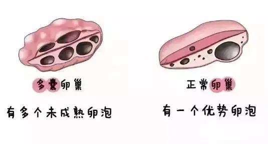 关于多囊卵巢综合症的16个问答,pcos多囊卵巢综合征的临床表现