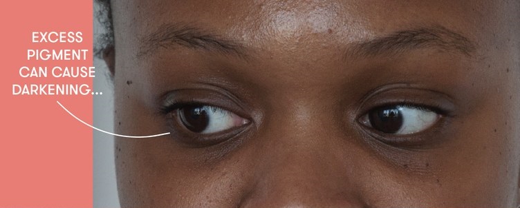 宝宝眼皮发黑什么原因,宝宝黑眼圈边缘有白边是怎么回事