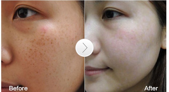 女人脸上有斑吃什么药可以祛斑,脸上长斑吃什么中药调理祛斑