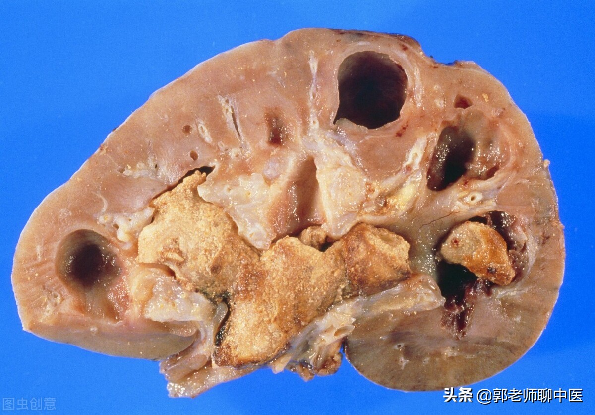 （收藏版）治疗肾结石的中药方剂，别找不到了