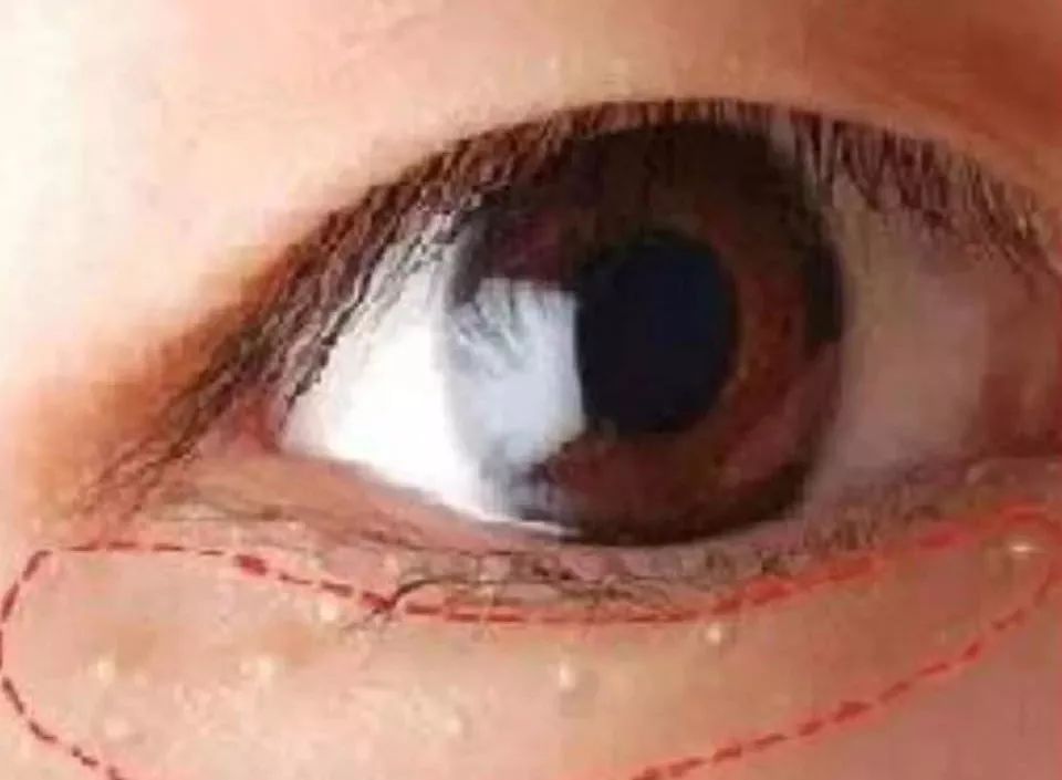 豁出小命说真话|脂肪粒真不是眼霜的错！粟丘疹这么做一针见效