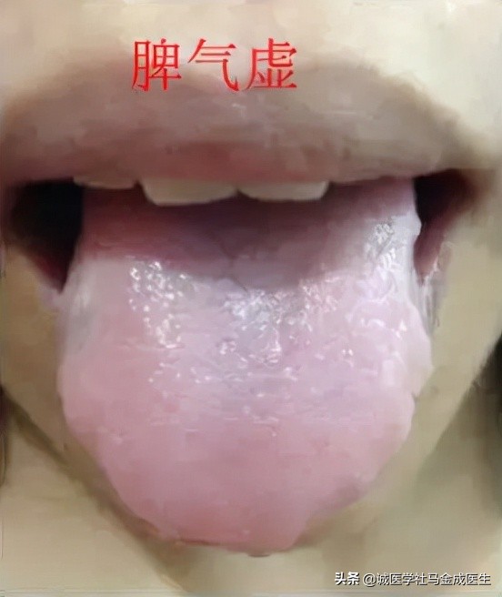 脾虚齿痕舌整天乏困吃什么中成药,治疗脾虚齿痕舌最好的中成药