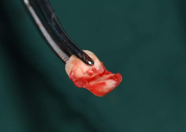 拔智齿根断在里面有什么危害,拔智齿牙根断在里面会怎么样