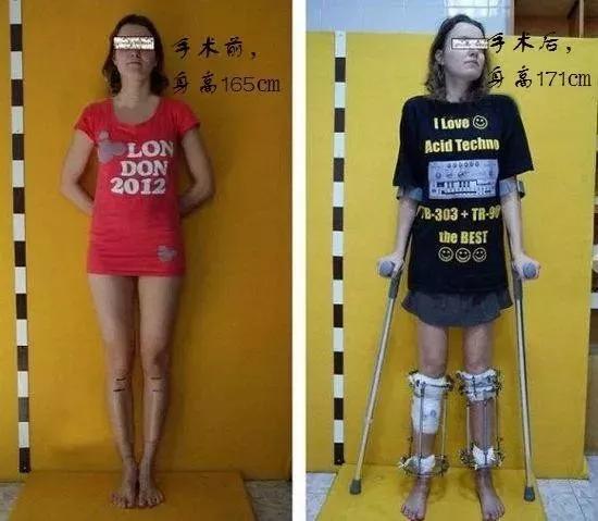 女子要做断骨增高手术,中国首例断骨增高术