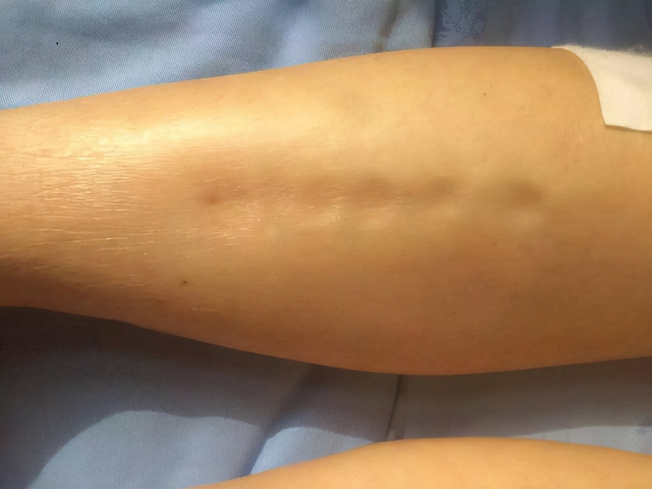 一喝水就尿多是肾脏出问题了吗,一喝水就尿多是肾好还是不好