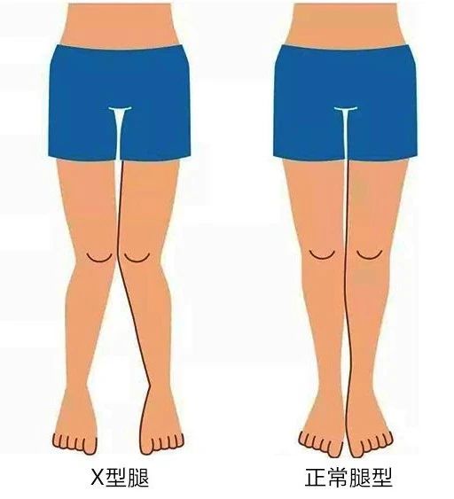 矫正腿型应该找谁,xo型腿矫正最快变直的方法视频
