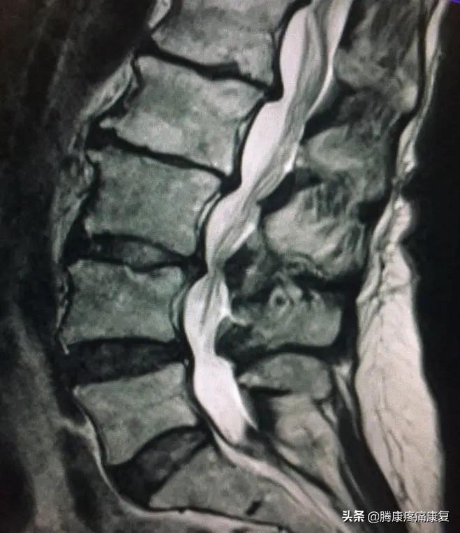 椎管狭窄走路腿疼怎么回事,腰椎管狭窄引起的腿疼